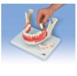Model - choroby zębów